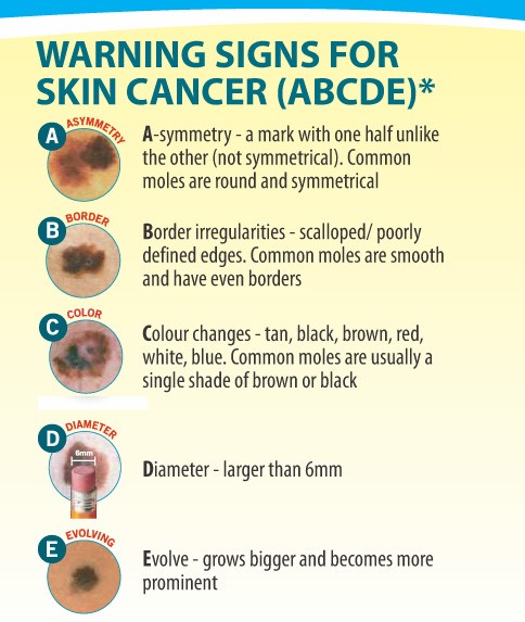 Warning Signs for skin cancer (ABCDE)